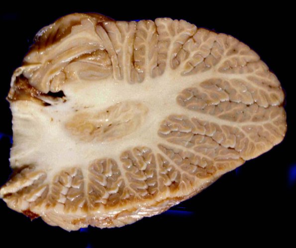 1A14 Cerebellum, normal - Hemisphere