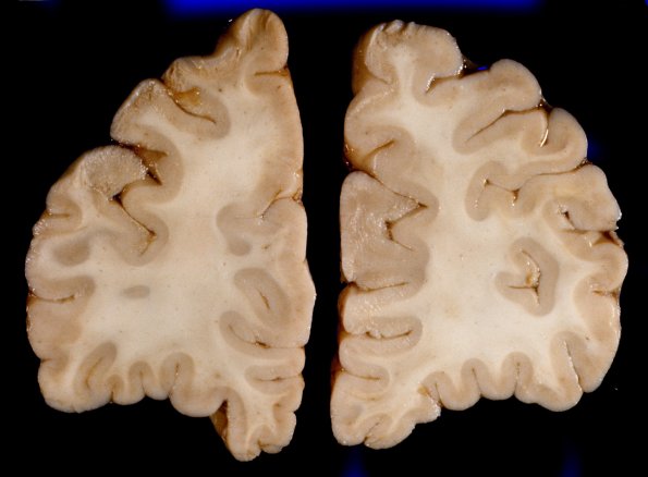 1A4 Brain, coronal, Section #1B