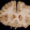 1A6 Brain, coronal, Section #3