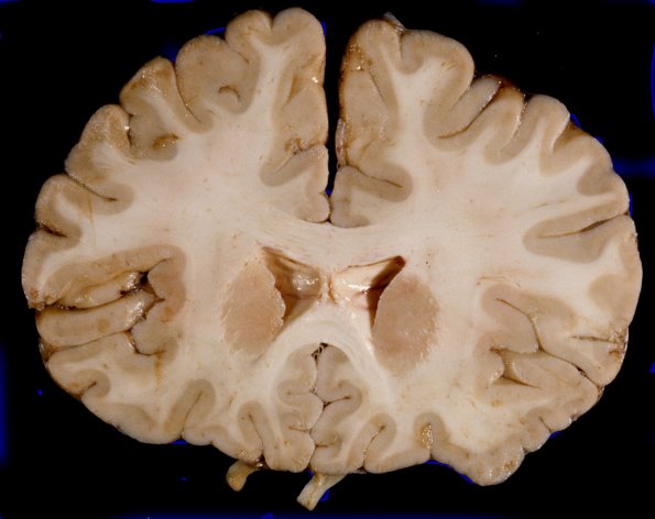 1A6 Brain, coronal, Section #3