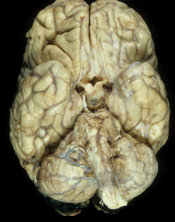 10A1 Neurosarcoidosis (Case 10) 2