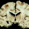 10A2 Neurosarcoidosis (Case 10) 4 copy