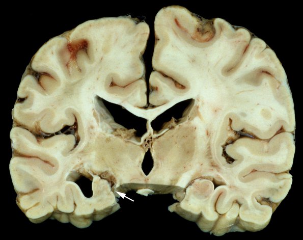 10A2 Neurosarcoidosis (Case 10) 4 copy