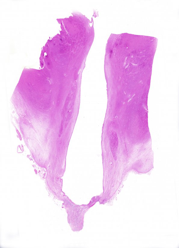 10A3 Neurosarcoidosis (Case 10) H&E 4