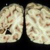 10B1 Neurosarcoidosis (Case 10) 6 copy