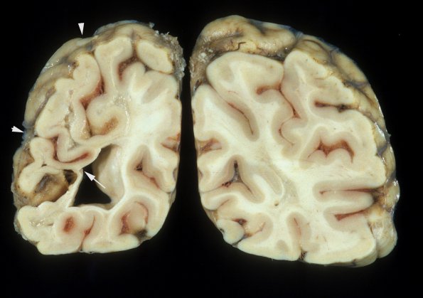 10B1 Neurosarcoidosis (Case 10) 6 copy