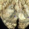 10B2 Neurosarcoidosis (Case 10) 3 copy