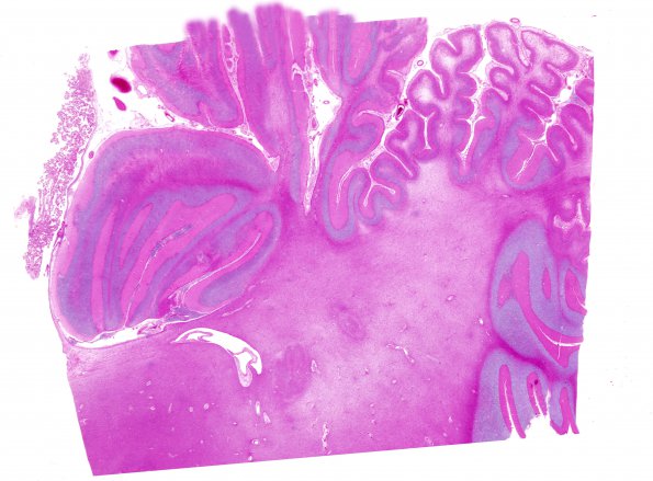 10C1 Neurosarcoidosis (Case 10) 10