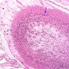 10C2 Neurosarcoidosis (Case 10) H&E 6 copy