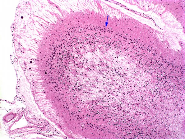 10C2 Neurosarcoidosis (Case 10) H&E 6 copy