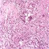 10C3 Neurosarcoidosis (Case 10) 9