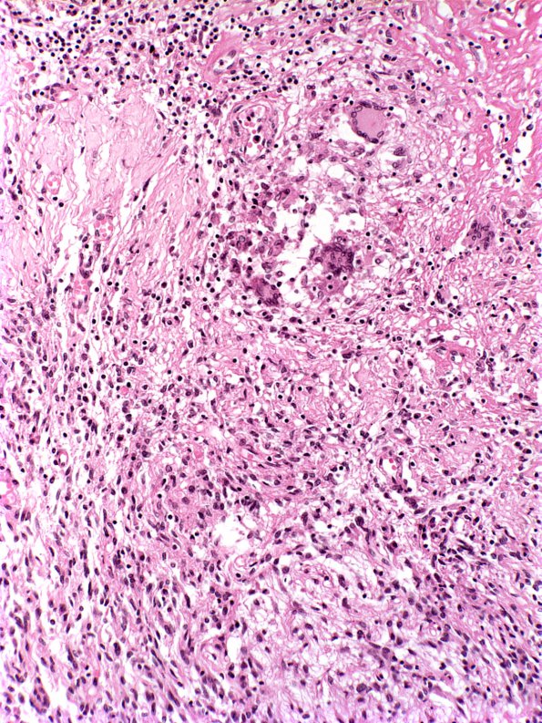 10C3 Neurosarcoidosis (Case 10) 9