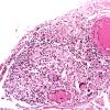 10C4 Neurosarcoidosis (Case 10) 7