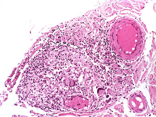 10C4 Neurosarcoidosis (Case 10) 7