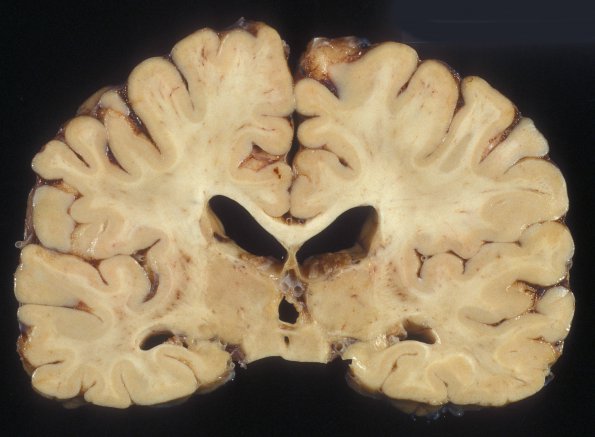 11A2 Neurosarcoid (Case 11) 1