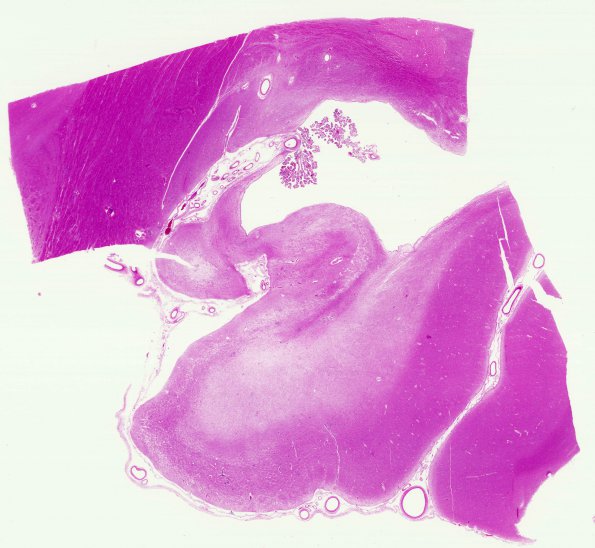 11B Neurosarcoid (Case 11) hippocampal sclerosis