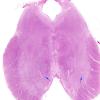 11D1 Neurosarcoid (Case 11) 6 copy