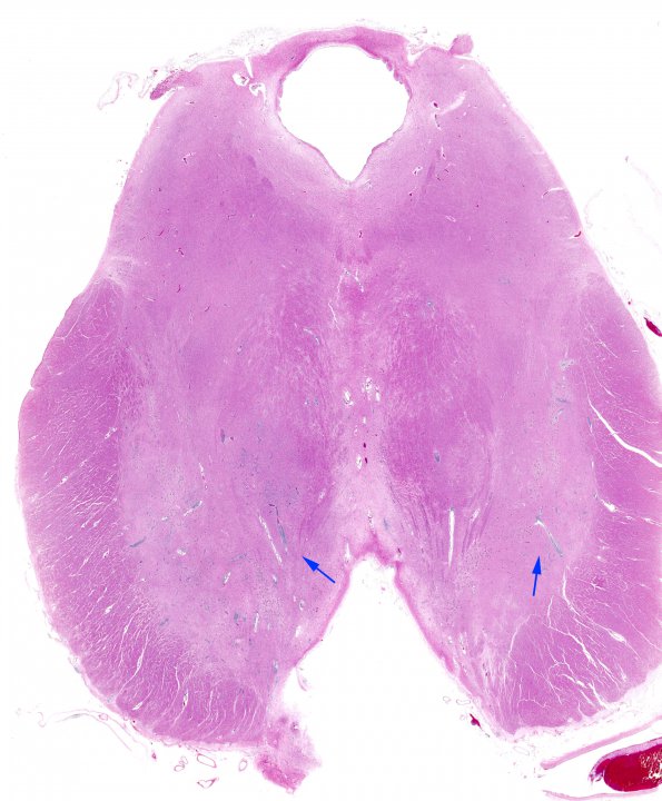 11D1 Neurosarcoid (Case 11) 6 copy