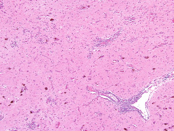 11D2 Neurosarcoid (Case 11) H&E 4