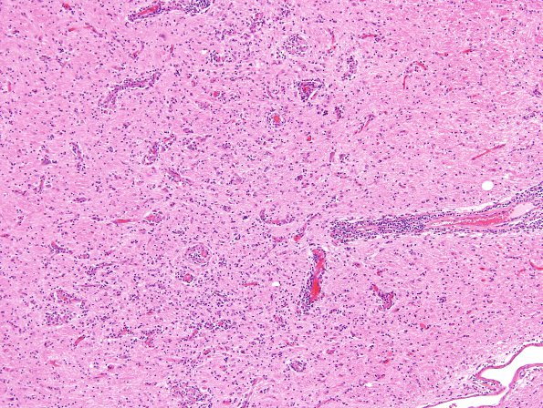 11D3 Neurosarcoid (Case 11) H&E 5