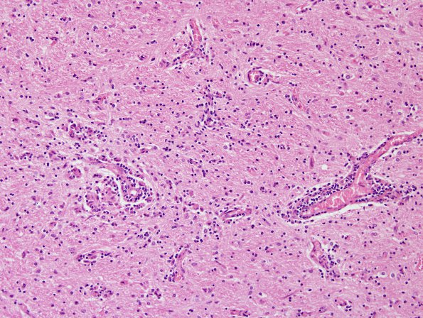 11D4 Neurosarcoid (Case 11) H&E 2