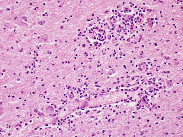 11D5 Neurosarcoid (Case 11) H&E 1