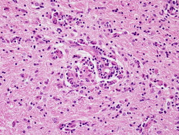 11D6 Neurosarcoid (Case 11) H&E 3