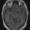 12A1 Neurosarcoid, optic tract (Case 12) T1 no contrast - Copy copy