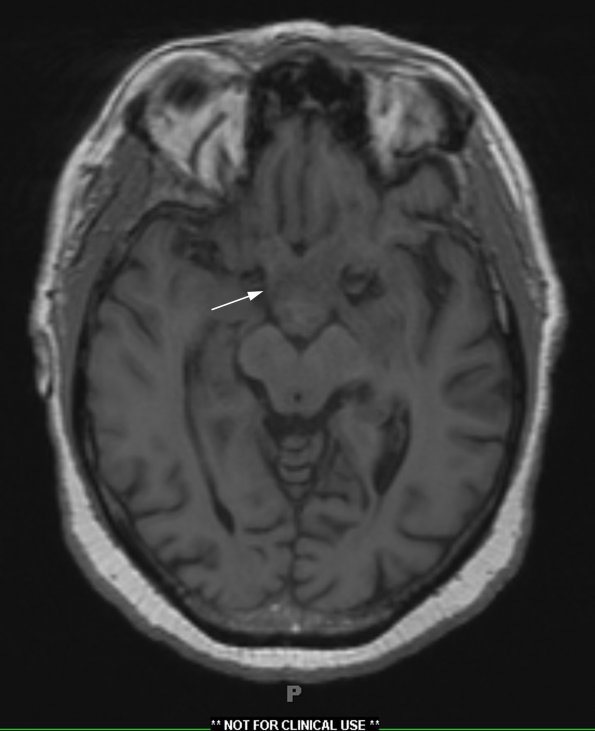 12A1 Neurosarcoid, optic tract (Case 12) T1 no contrast - Copy copy