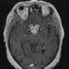 12A2 Neurosarcoid, optic tract (Case 12) T1 with contrast - Copy