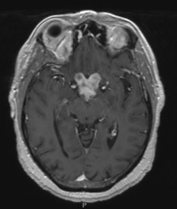 12A2 Neurosarcoid, optic tract (Case 12) T1 with contrast - Copy