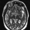 12A3 Neurosarcoid, optic tract (Case 12) T2 with contrast - Copy