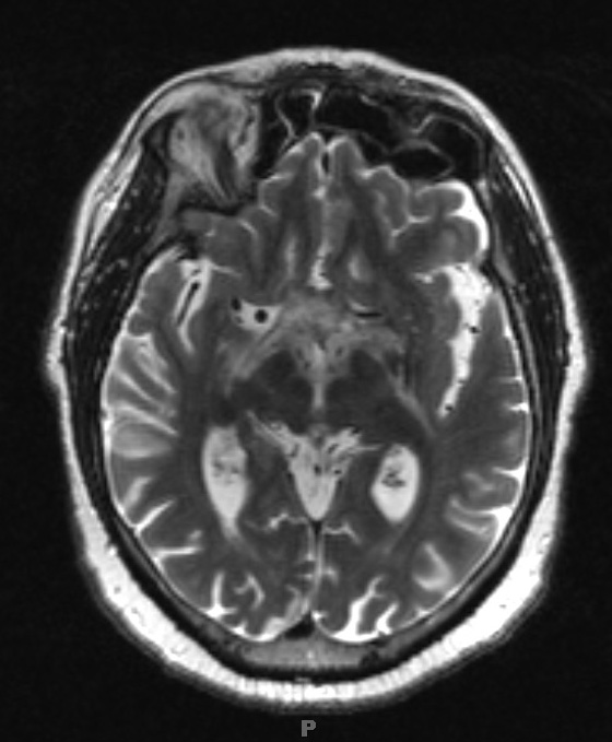 12A3 Neurosarcoid, optic tract (Case 12) T2 with contrast - Copy