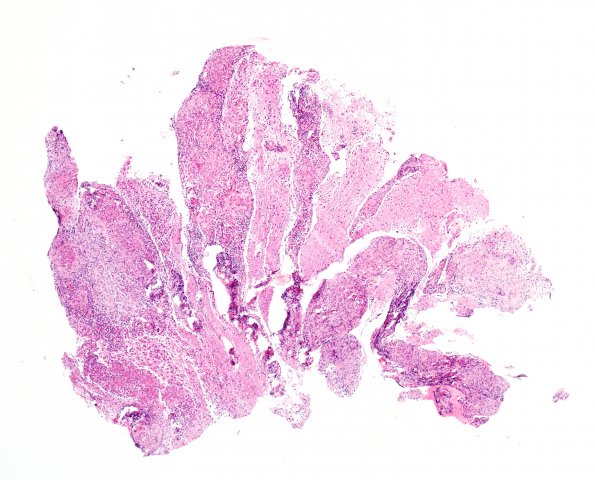 12B1 Sarcoid, non-necrotizing granulomas, optic chiasm (Case 12) 1 H&E