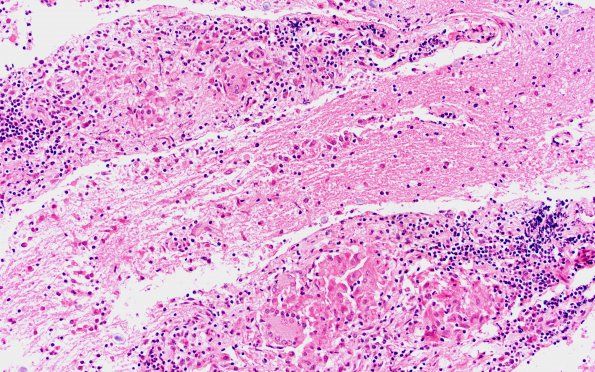 12B2 Sarcoid, non-necrotizing granulomas, optic chiasm (Case 12) H&E 2