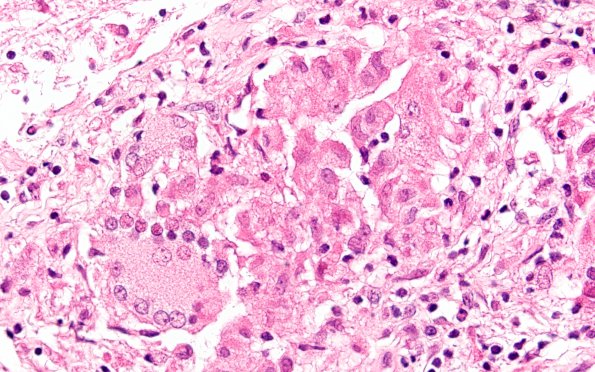 12B3 Sarcoid, non-necrotizing granulomas, optic chiasm (Case 12) H&E 1