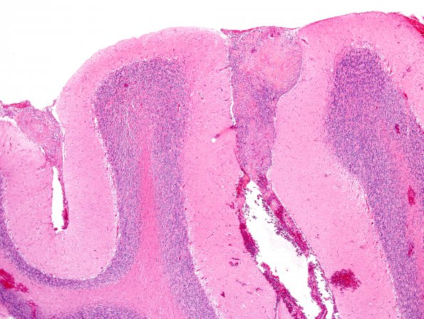 13A1 Sarcoid (granulomatous inflammation with no bugs, Case 13) H&E 3