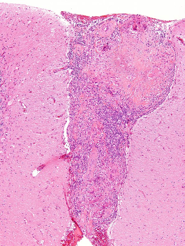 13A2 Sarcoid (granulomatous inflammation with no bugs, Case 13) H&E 1