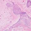 13A3 Sarcoid (granulomatous inflammation with no bugs, Case 13) H&E 1A