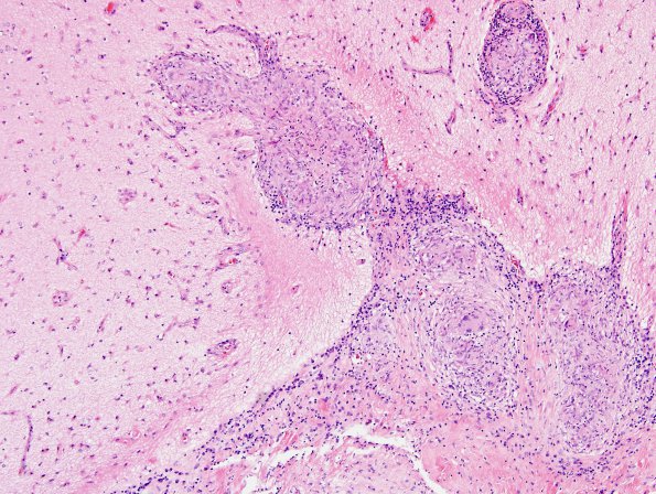 13A3 Sarcoid (granulomatous inflammation with no bugs, Case 13) H&E 1A