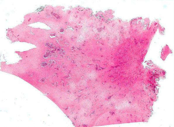 14A1 Sarcoidosis (hilar nodes positive, AANP 1991, Case 7) H&E X0.5