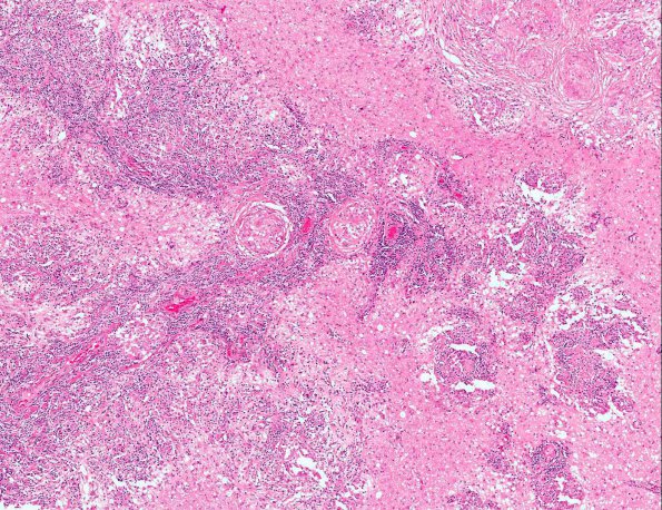 14A2 Sarcoidosis (hilar nodes, AANP 1991, Case 7) H&E X5