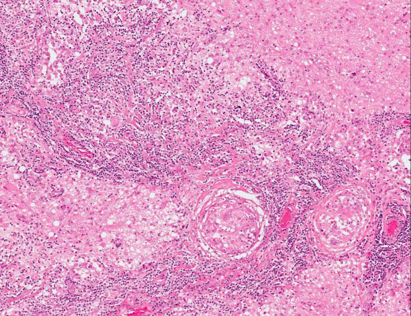 14A3 Sarcoidosis (hilar nodes positive, AANP 1991, Case 7) H&E X10 1