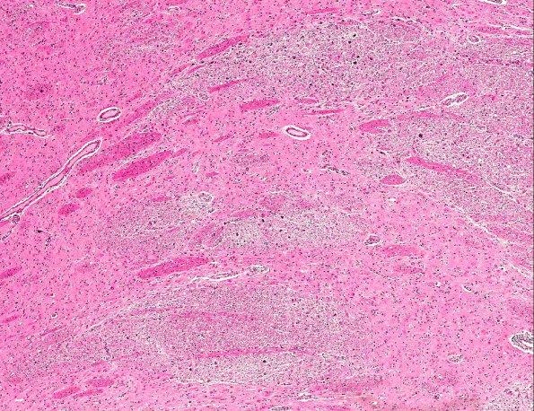 15A2 Sarcoidosis, meningo-encephalitic form (AANP 1999-Case 10) H&E X4 1