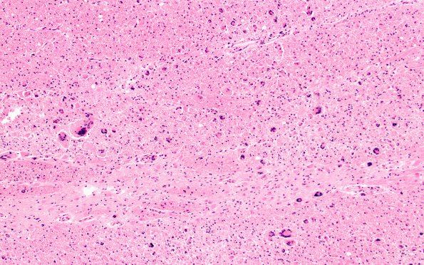 15A3 Sarcoidosis, meningo-encephalitic form (AANP 1999-Case 10) Glass slide H&E 2