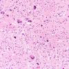 15A4 Sarcoidosis, meningo-encephalitic form (AANP 1999-Case 10) Glass slide H&E 1