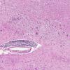 15A5 Sarcoidosis, meningo-encephalitic form (AANP 1999-Case 10) H&E H&E 2