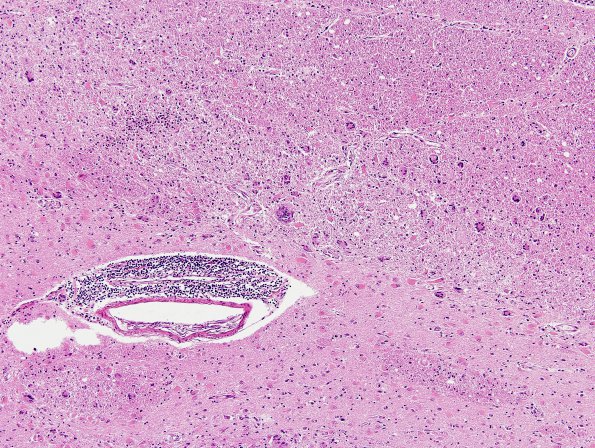 15A5 Sarcoidosis, meningo-encephalitic form (AANP 1999-Case 10) H&E H&E 2