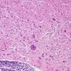 15A6 Sarcoidosis, meningo-encephalitic form (AANP 1999-Case 10) H&E 1