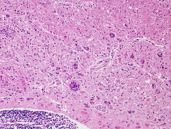 15A6 Sarcoidosis, meningo-encephalitic form (AANP 1999-Case 10) H&E 1